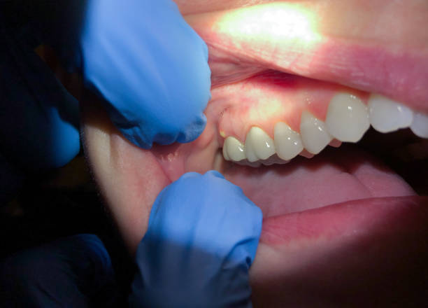 Best Emergency Broken Tooth Repair in Mineola, TX