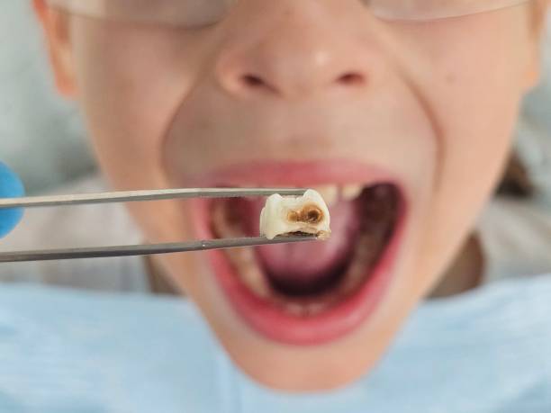 Best Emergency Wisdom Teeth Removal in Mineola, TX